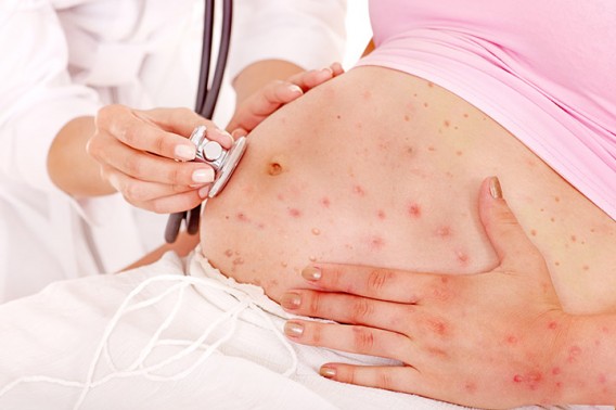treatment of chickenpox in pregnancy
